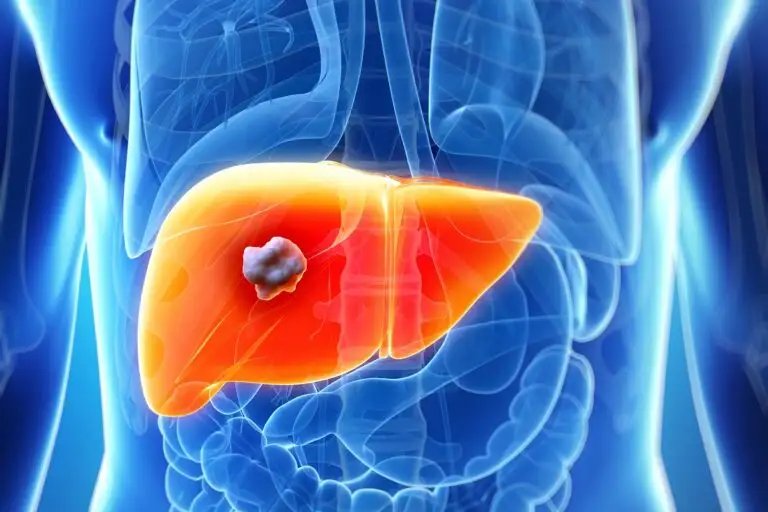HIV Patient Develops Liver Abscess Due To Fungal Infection: Watch Out For These Symptoms