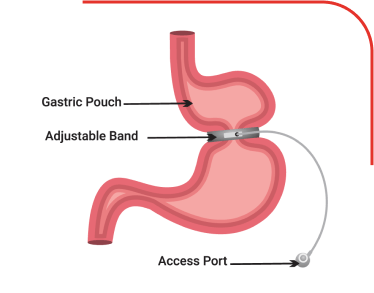 Adjustable Gastric Band Surgery