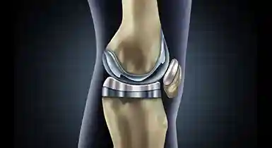 Knee Replacement: Golden Solution for Metal Implant Allergies