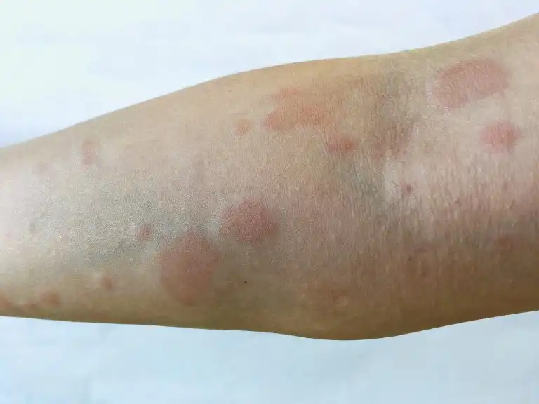 Lupus – The Disease That Can Present Just With Joint Pains Initially