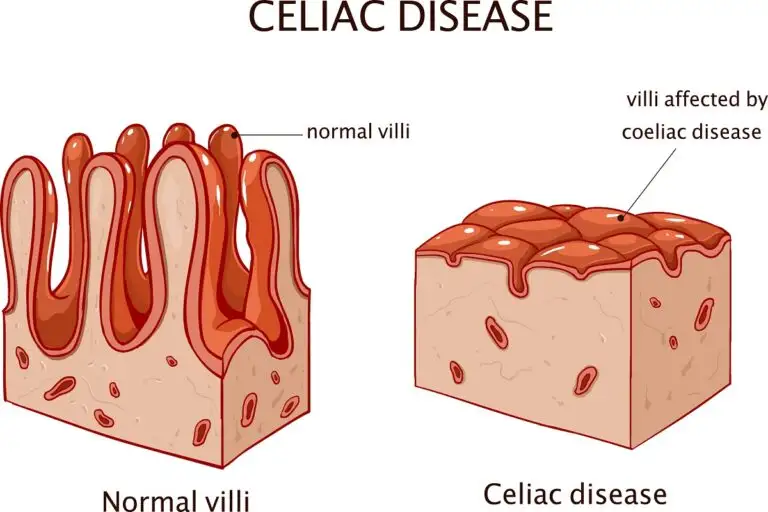 What is celiac disease, the condition that Miss Universe 2021 Harnaaz Sandhu suffers from?