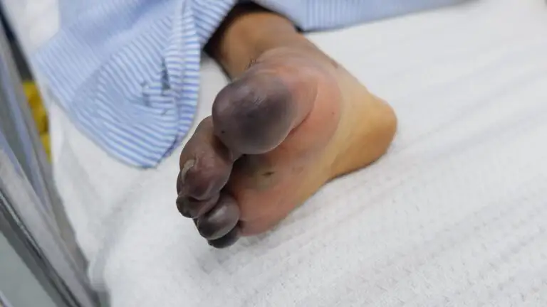 Doctors Saved Geriatric’s Leg from Amputation