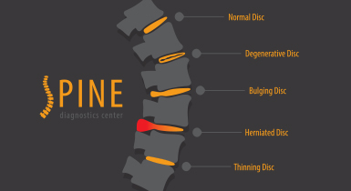 herniated disc