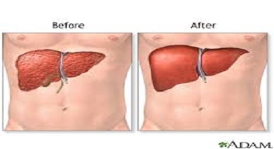Liver Transplant in India