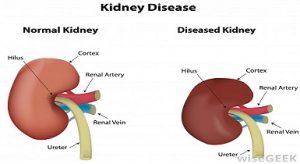 Types of kidney disease