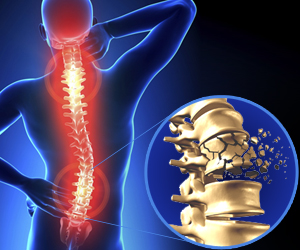 Spinal Cord Injury