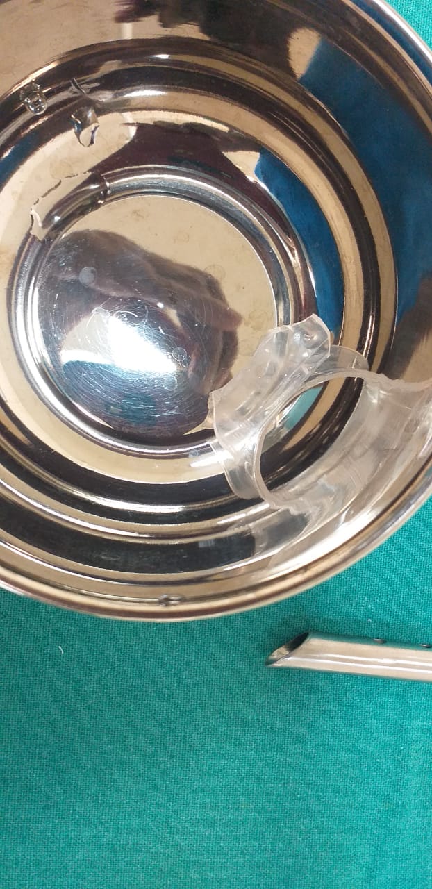 Bottle Cap Stuck In An Infant's Throat