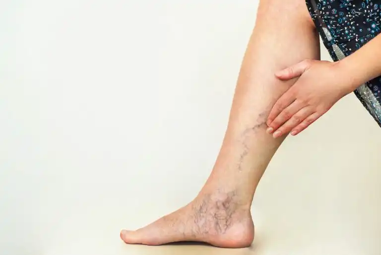 How to Treat Varicose Veins?