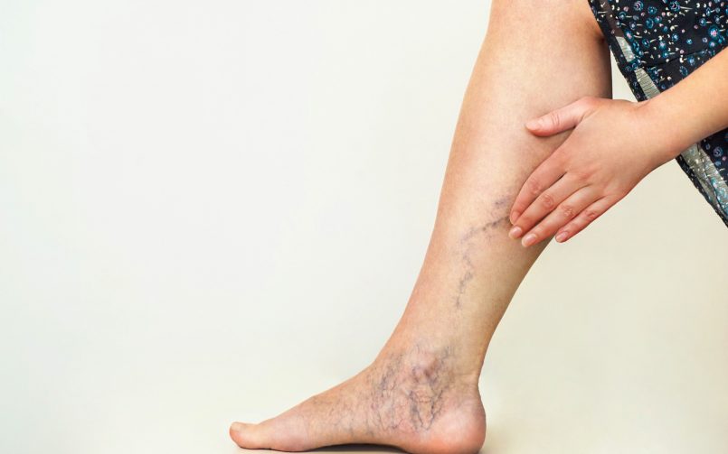 Varicose vein