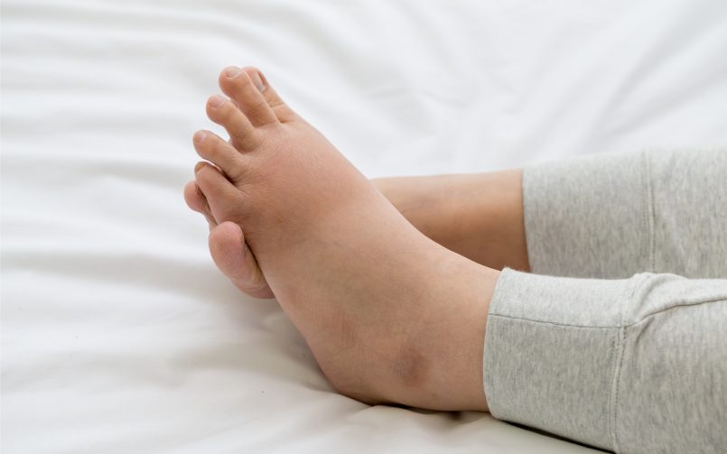 Swelling in Leg