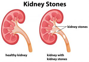 Kidney Stones