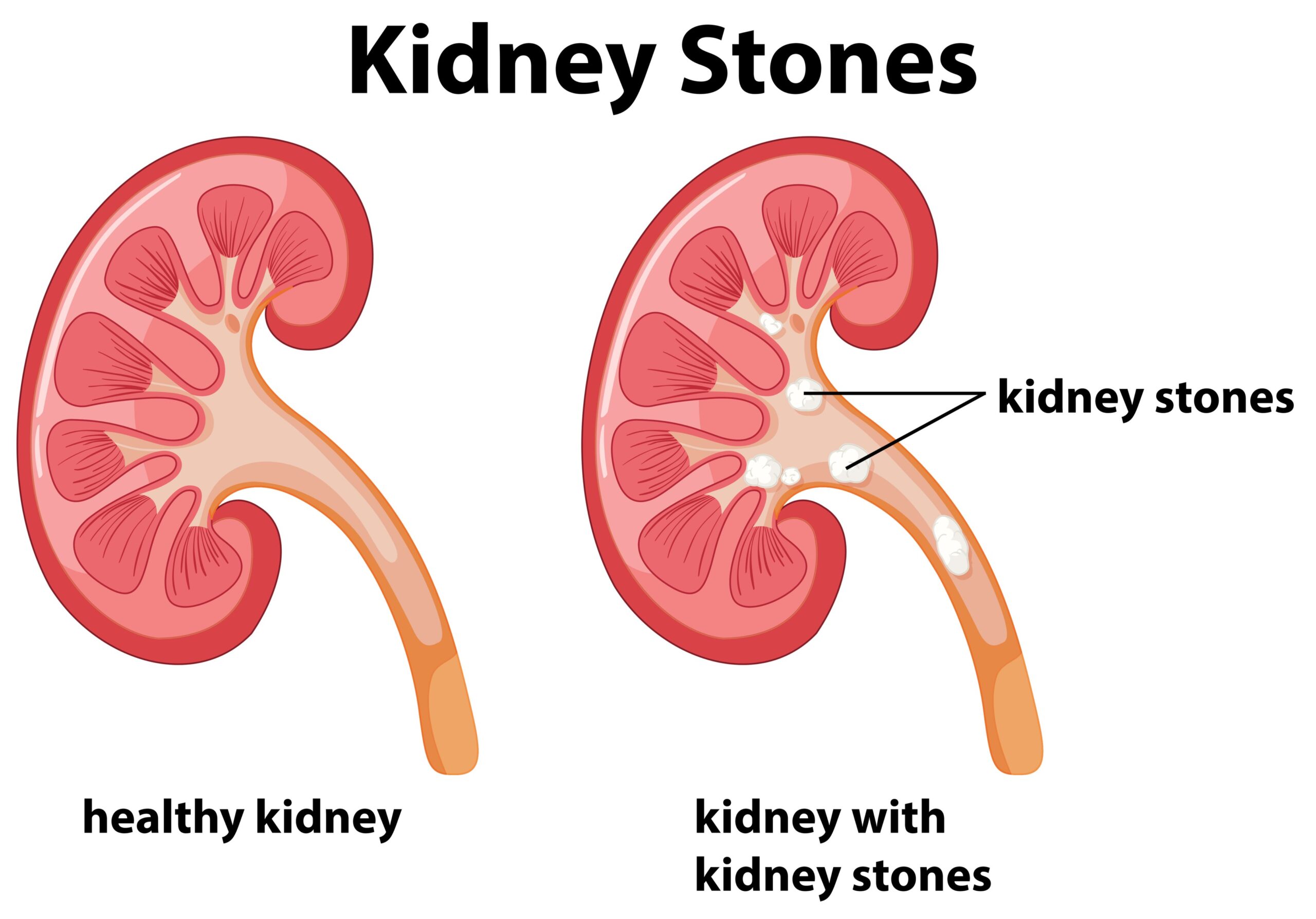 Differential Diagnosis of Flank Pain, PDF, Kidney