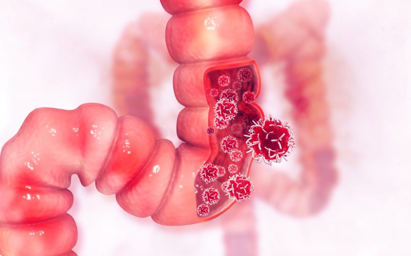 Rectum Cancer
