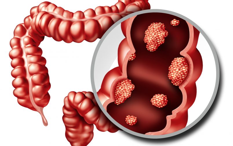 Colon Cancer