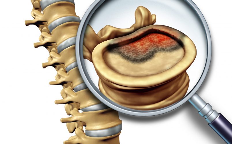 Intradural Spinal Cord tumor