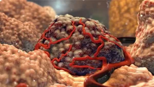 Neuroendocrine Tumour