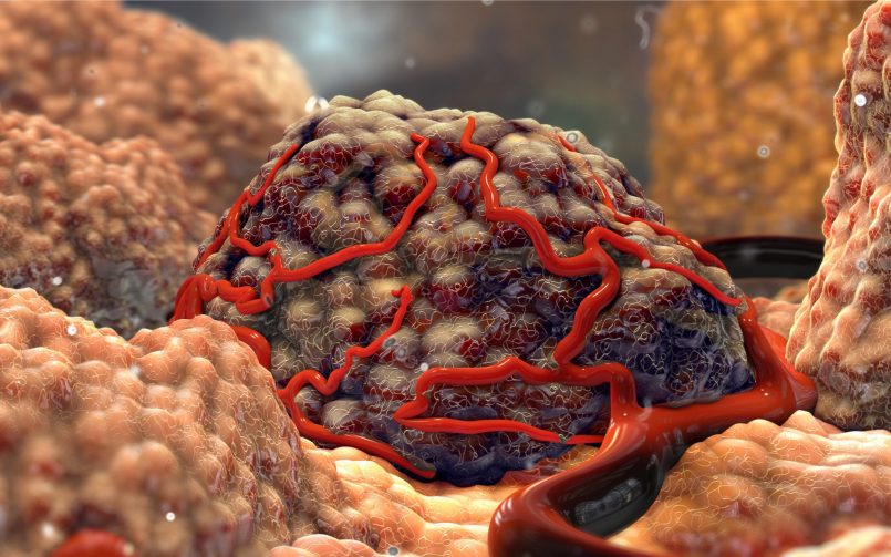 NET Tumour