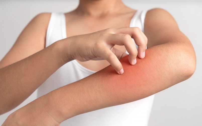 Skin allergy during monsoon