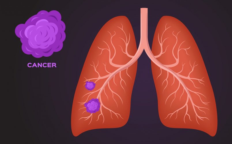 Lung Tumour