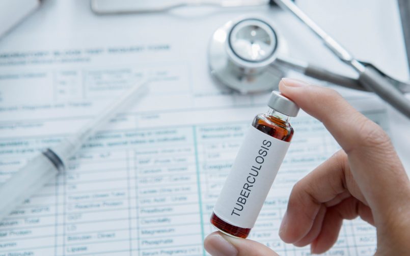 Tuberculosis