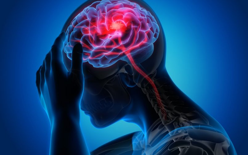 brain stroke