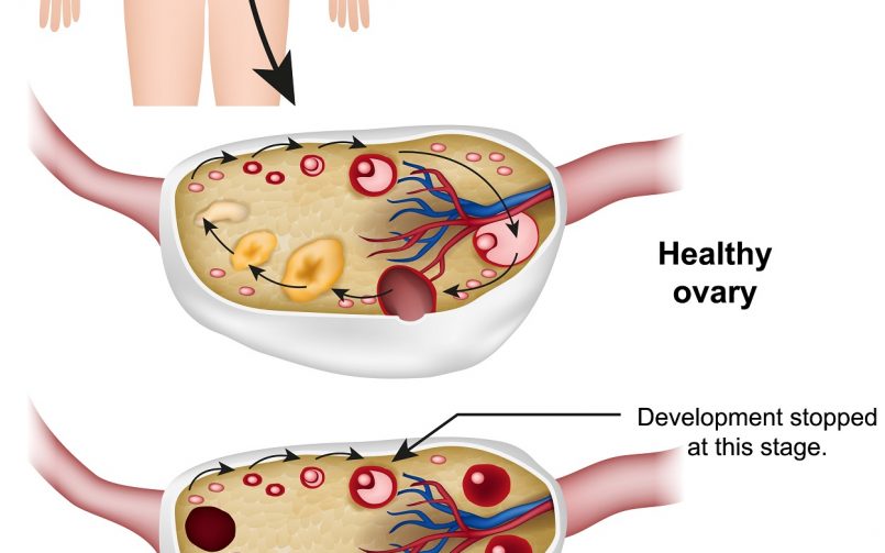 polycystic ovarian syndrome
