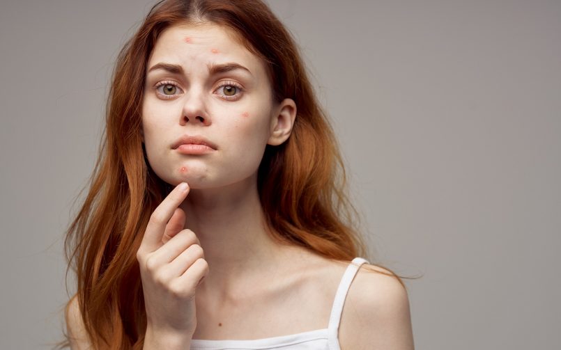 Biggest causes behind acne