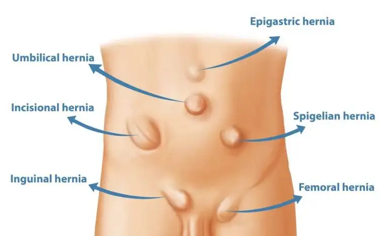 Hernia