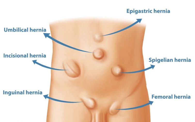 Hernia – Causes, Types, Diagnosis & Advanced Treatment