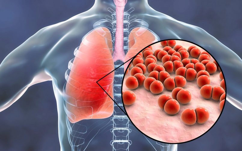 An expert explains why covid-19 pneumonia can be deadly in many ways |  COVID-19