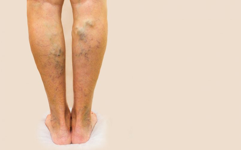 Varicose Veins