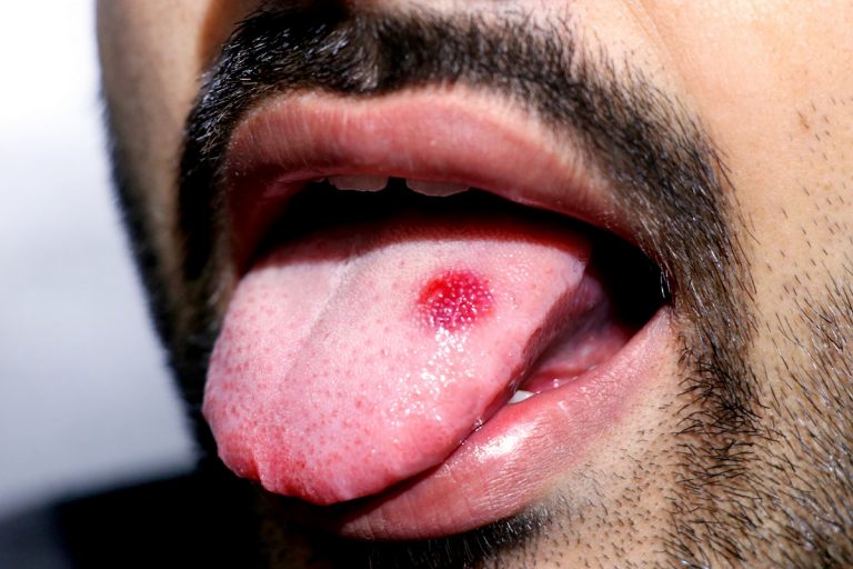 24-year-old woman with tongue cancer sings again after treatment