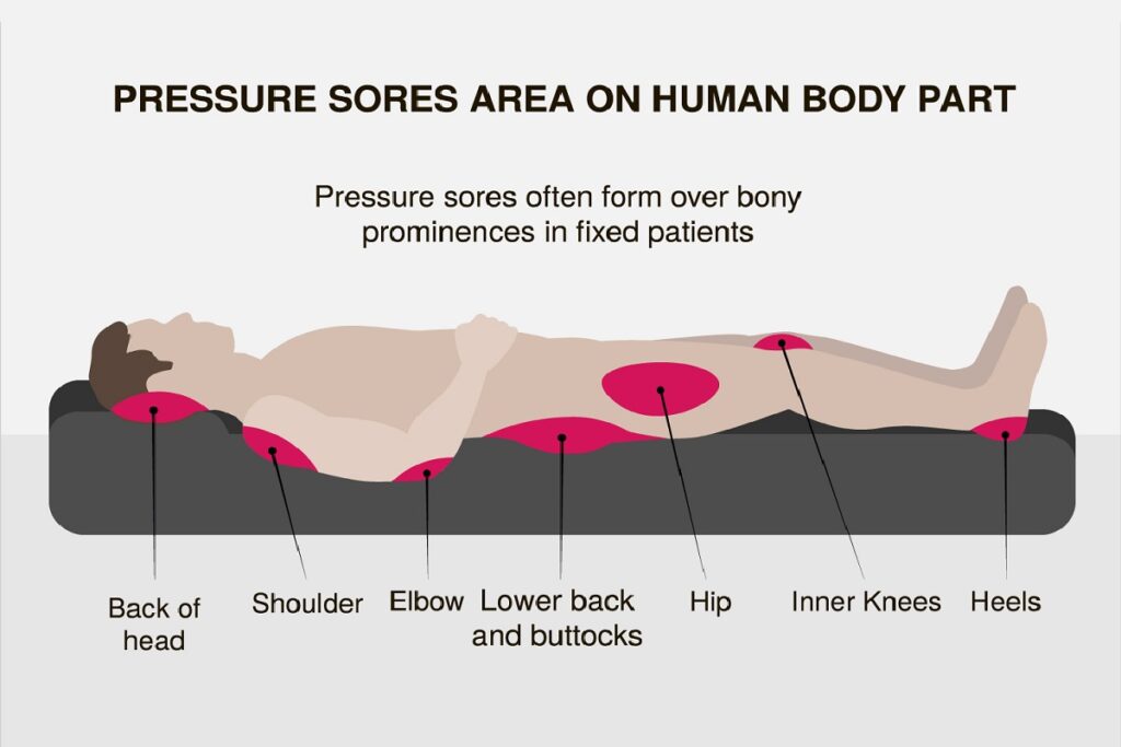 Wockhardt Education Initiative: How Pressure Ulcers (Bed Sore) kills ...