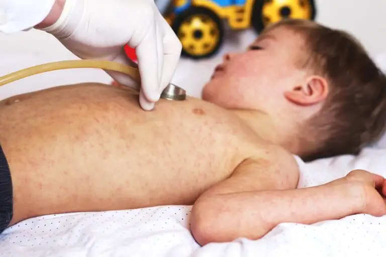 Measles