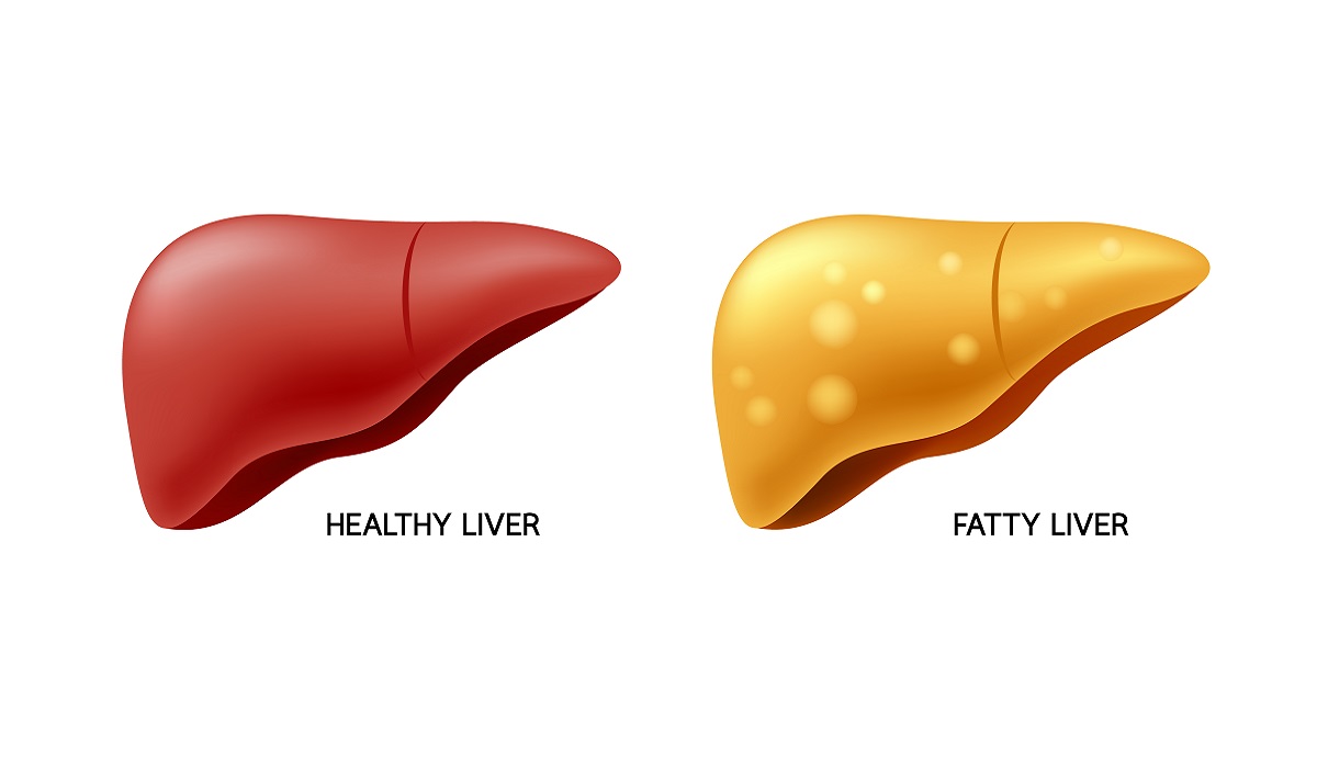 Fatty Liver Wockhardthospitals