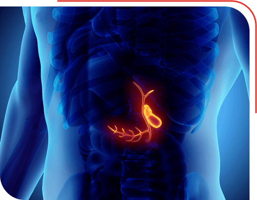 Cholecystectomy Surgery