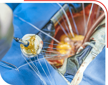 Heart Valve Surgery