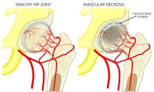 Stages of Avascular Necrosis
