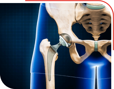 Hip Replacement Surgery
