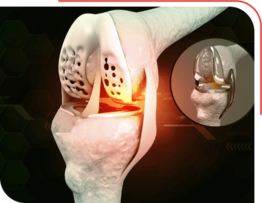 Knee Replacement Surgery