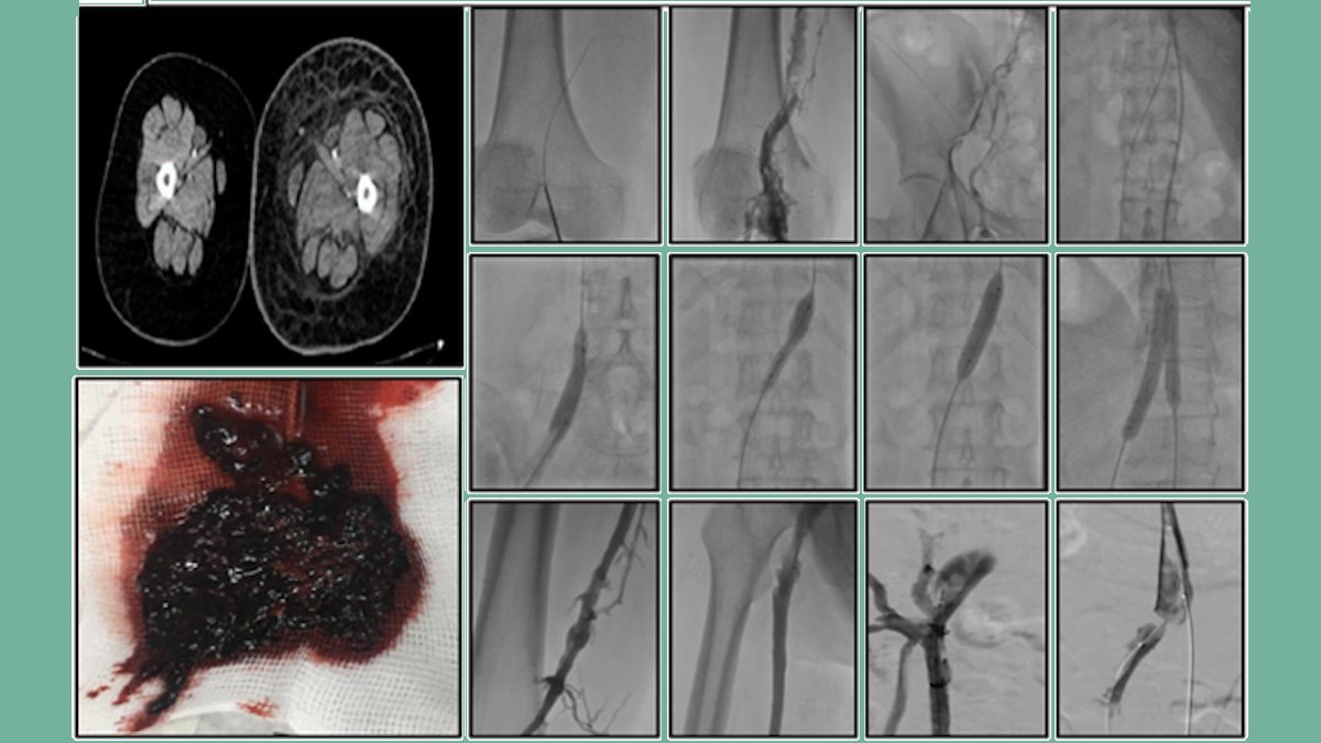 Deep Veinthrombosis Treatment