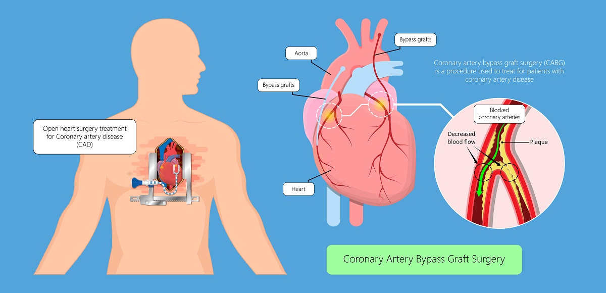 Coronary Artery Bypass Graft Diagram