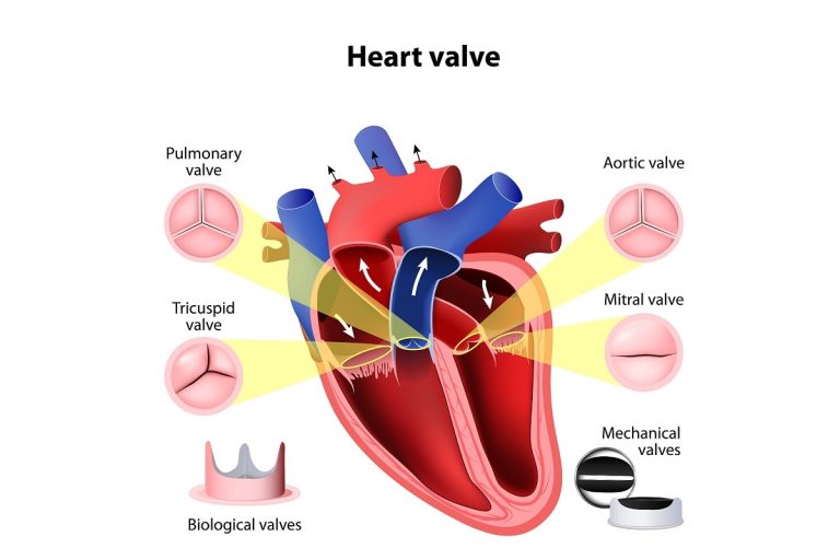 Heart Valve Surgery