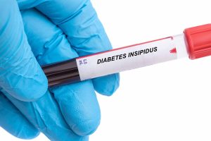 Diabetes Insipidus