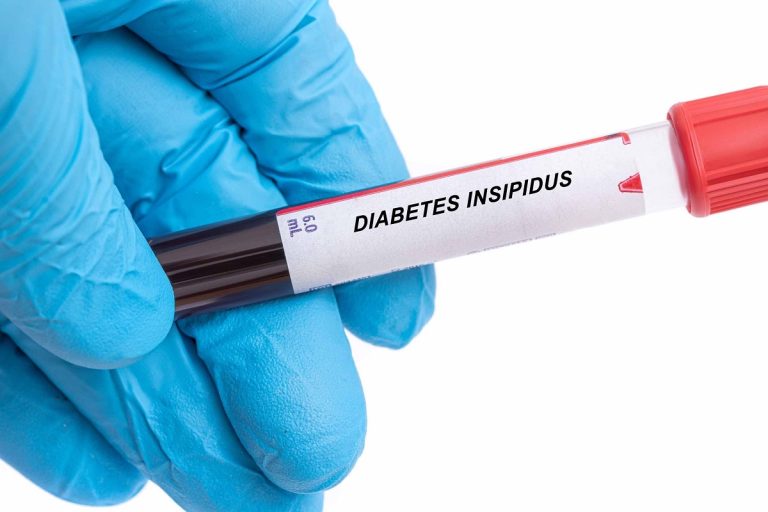 Diabetes Insipidus