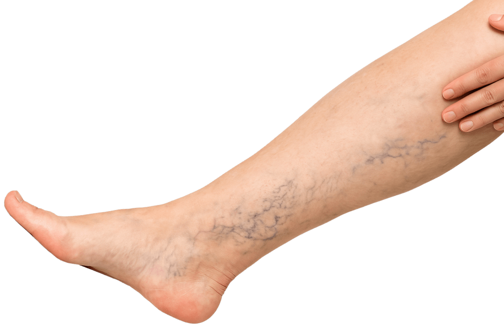 Varicose Veins Treatment