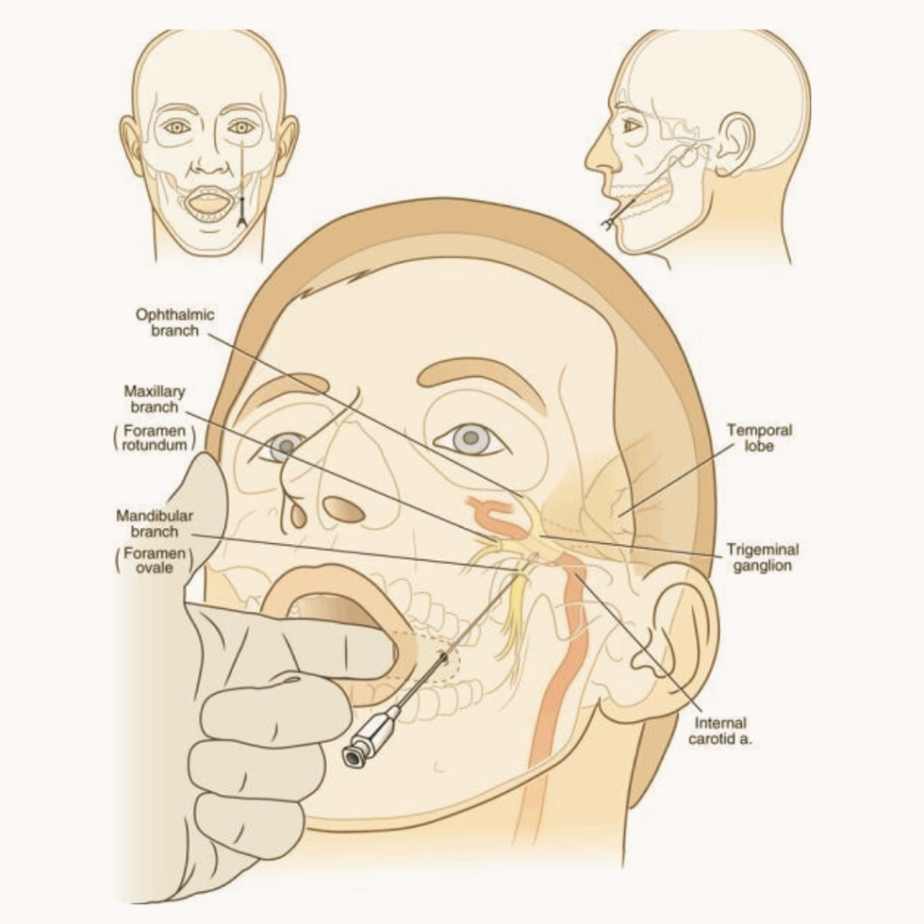 Lesioning Procedure