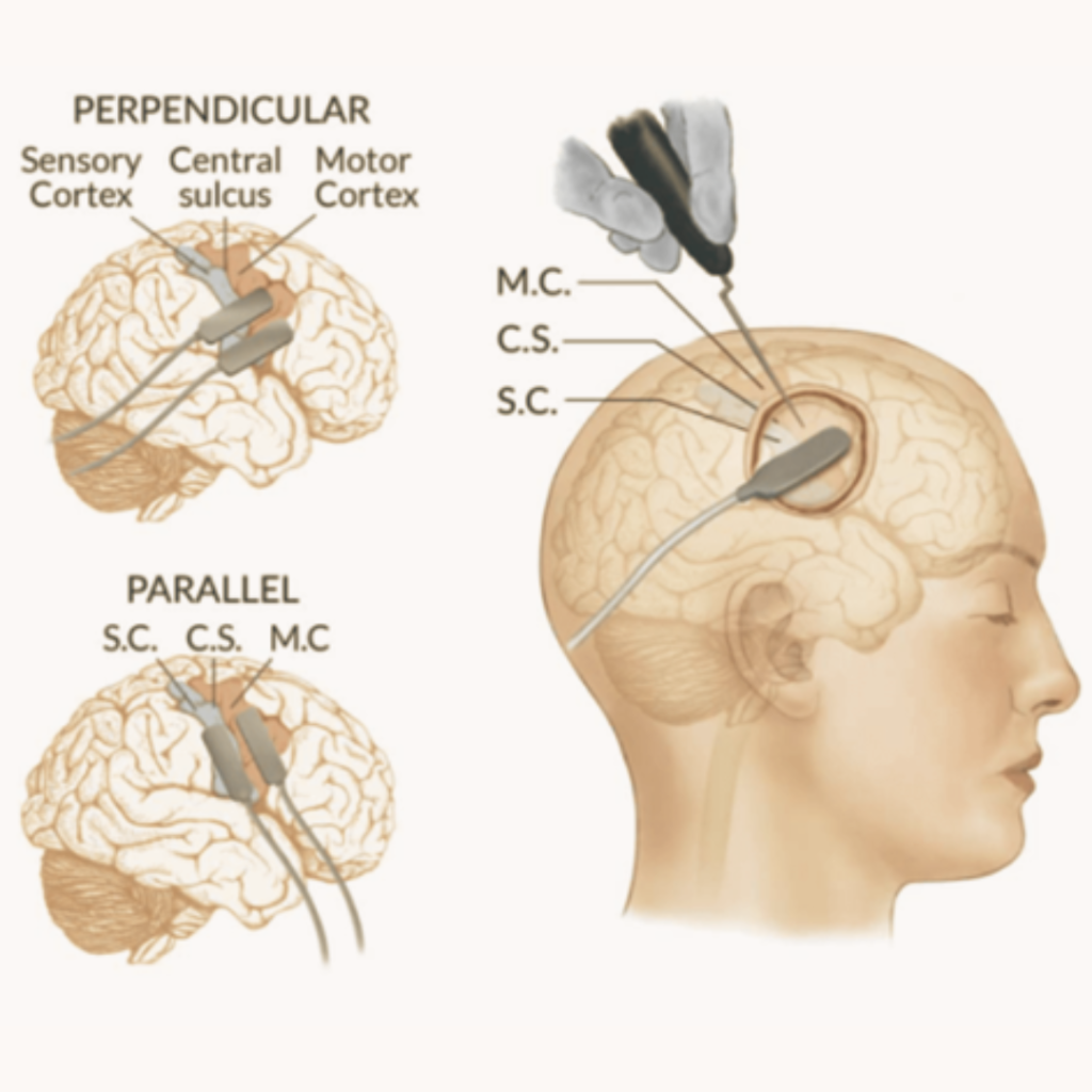 Motor Cortex Stimulation (MCS)